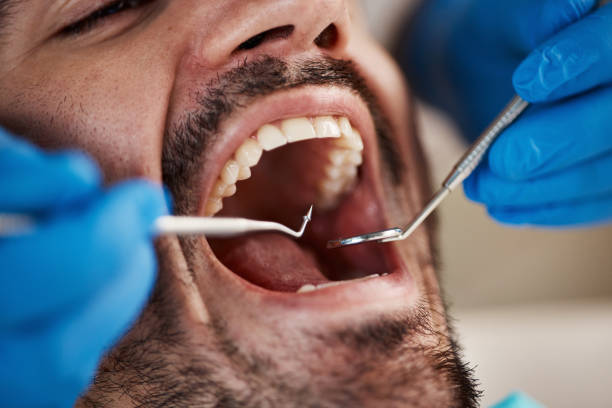 Best Knocked-Out Tooth (Avulsed Tooth) Treatment in Guthrie, KY